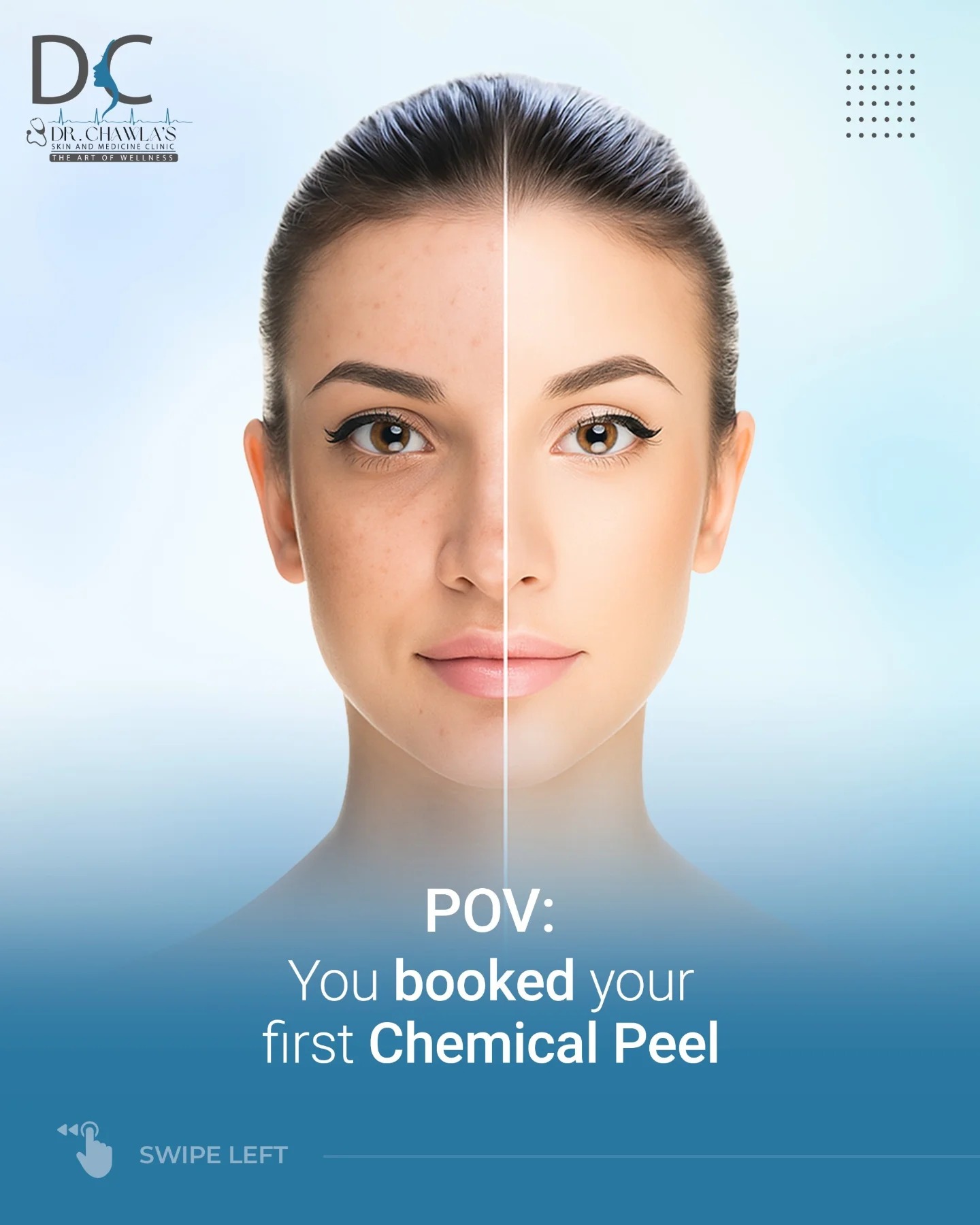 chemical peel treatment in Zirakpur