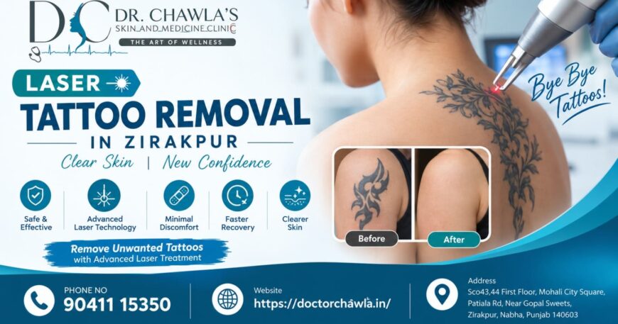 Laser Tattoo Removal in Zirakpur
